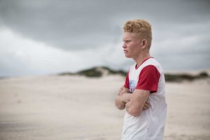 albinos